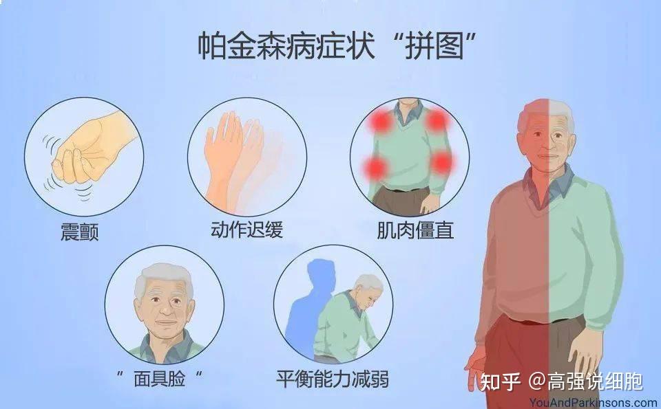 干细胞干预帕金森第一讲帕金森的病因症状及干细胞的临床研究