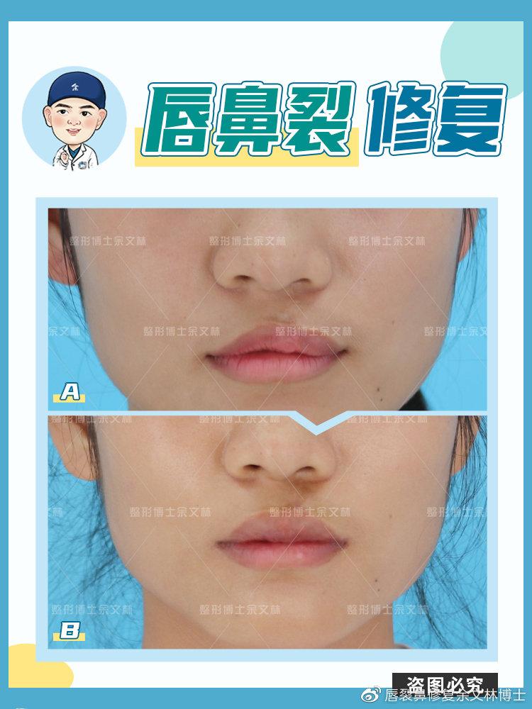 兔唇(唇裂)第二次修复手术,多久可以见效? - 知乎