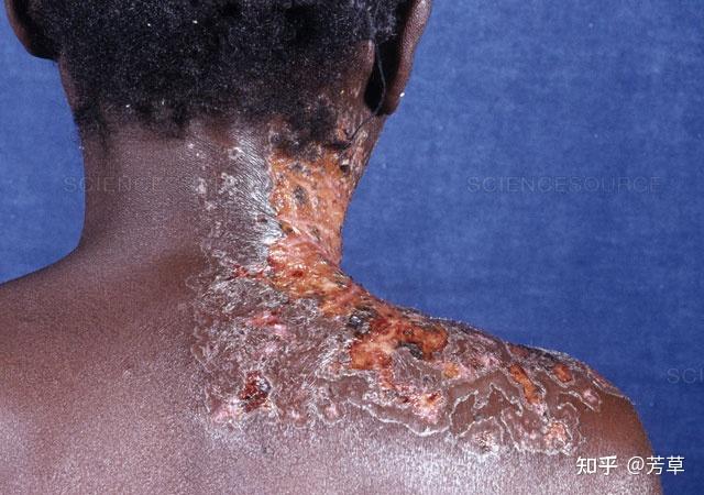艾滋病感染触目惊心胆小者慎看