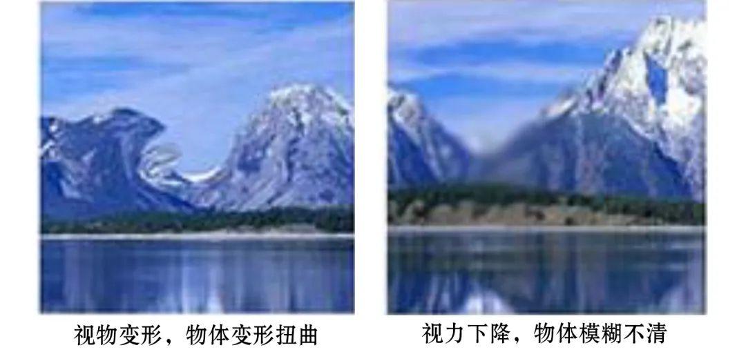 黄斑前膜 || 黄斑区多长了一层“膜”严重损害视力 - 知乎