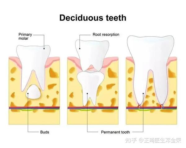 正畸治疗引发牙根吸收的原因和敏感因素 - 知乎
