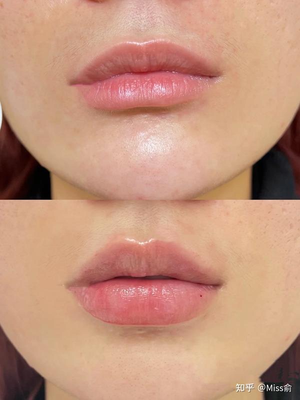 玻尿酸丰唇是怎样的体验?