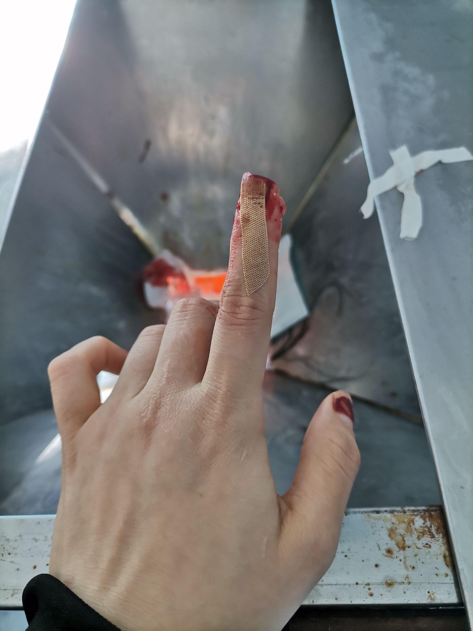 手指切断了还能康复吗? - 知乎