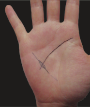 出现典型的菱形纹,则容易发生乳腺增生,并且有可能需要手术.