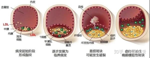 做完支架後,血管內的斑塊去哪了?