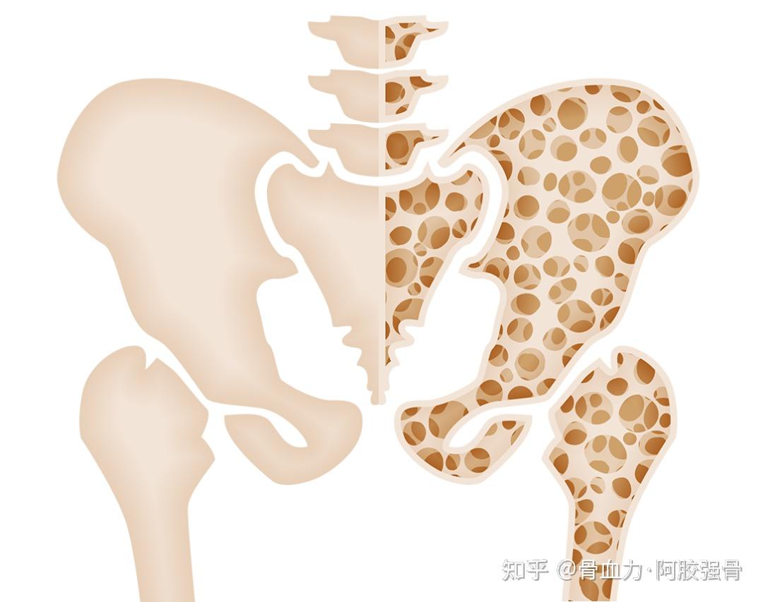 科普小课堂——关于骨质疏松症:您需要记住十句话! - 知乎