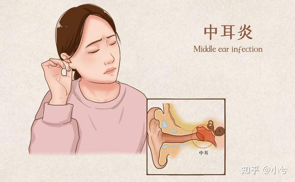 中耳炎怎么治疗? - 知乎