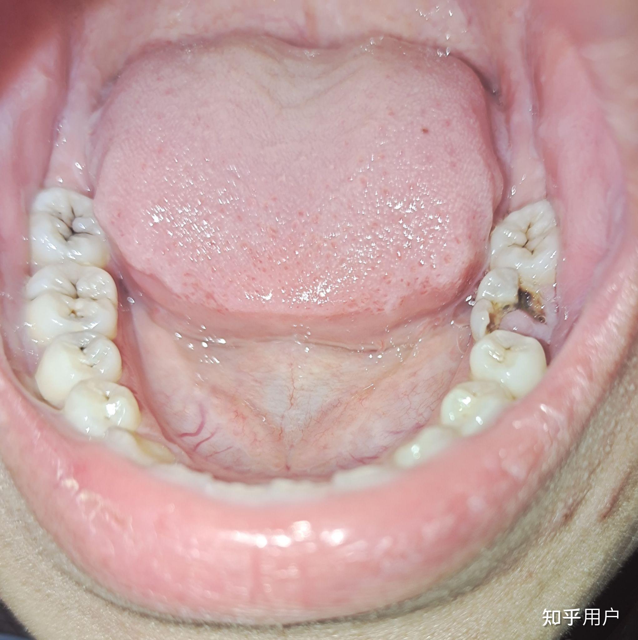 成年人有24颗牙正常吗? - 知乎