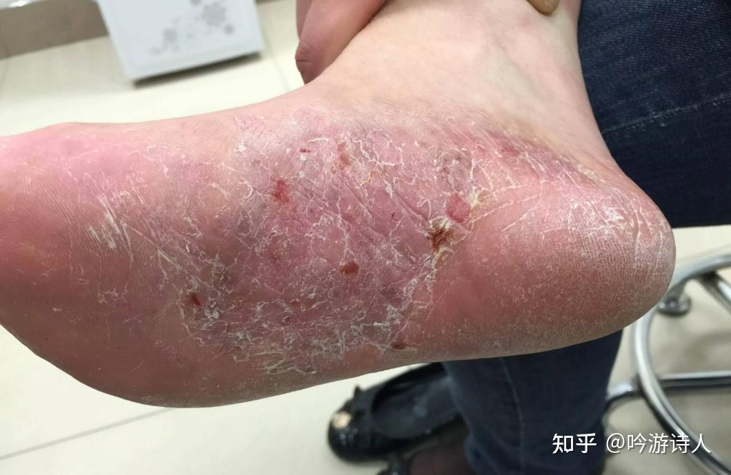 脚气太严重会怎样