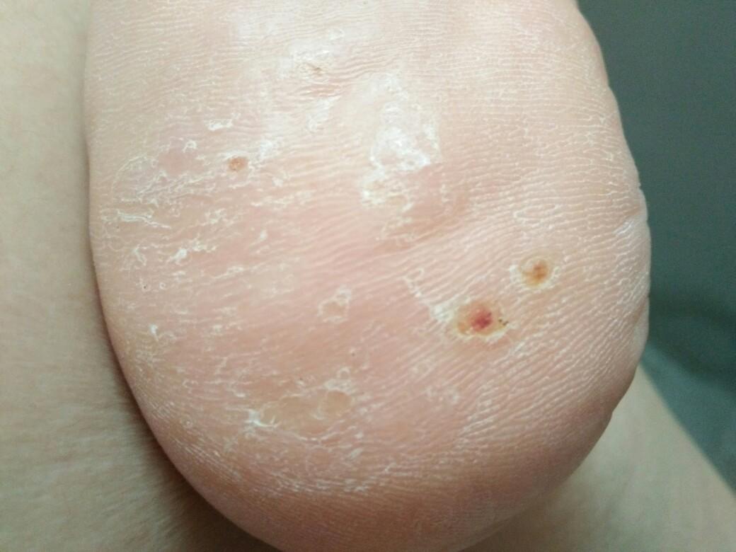 脚后跟长了很多的疣 看了很久的医生 做过冷冻