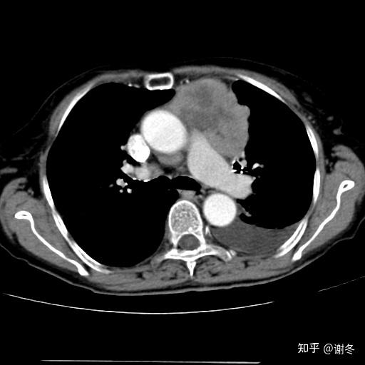 咳嗽咳痰,乏力,体重下降等,与胸腺瘤极为相似,部分患者可无任何症状