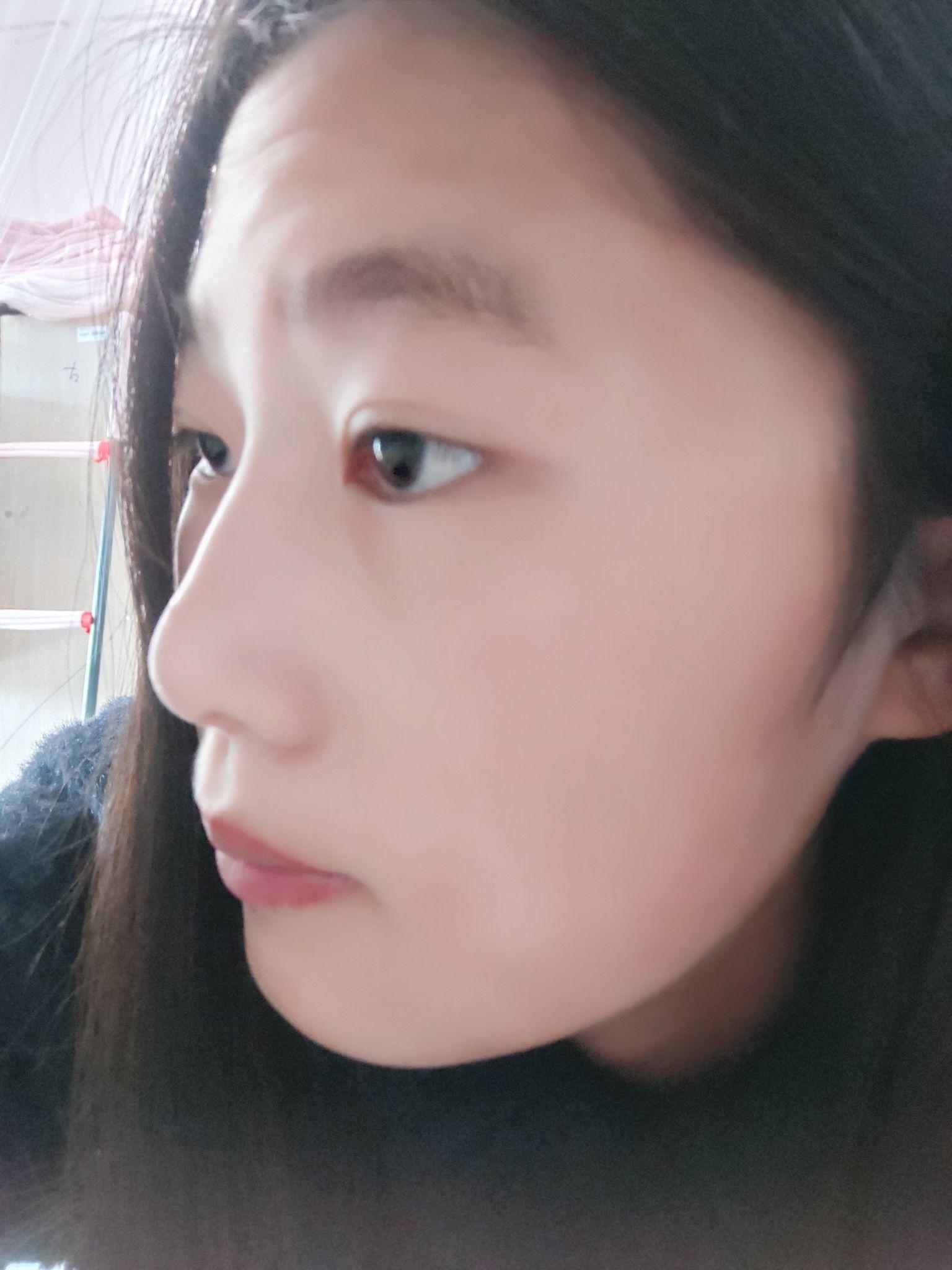 塌鼻梁是怎么回事 v2-5f153cb13dde81e0b893885b760f1f1c_r.jpg