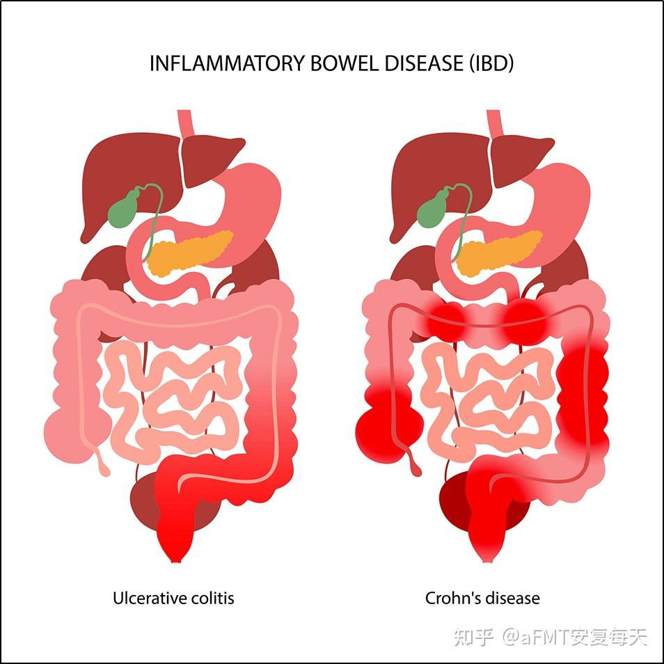 try-a-fodmaps-diet-to-manage-irritable-bowel-syndrome-harvard-health