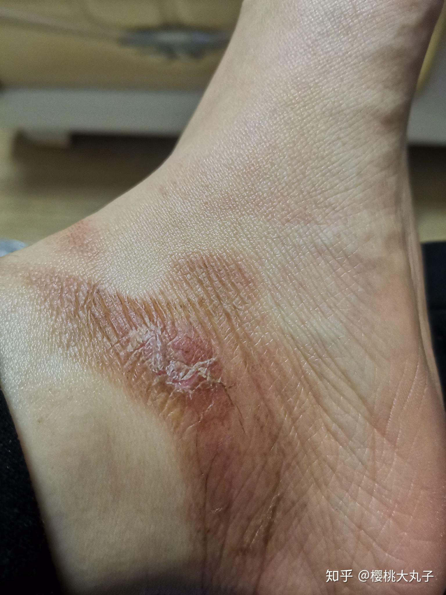 表皮剪掉能看到里面好像还不错,准备买点祛疤痕的药试试,希望不要留疤