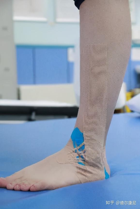 肌内效贴的贴扎看似简单,实则可是有讲究的,既要考虑贴扎位置,还要