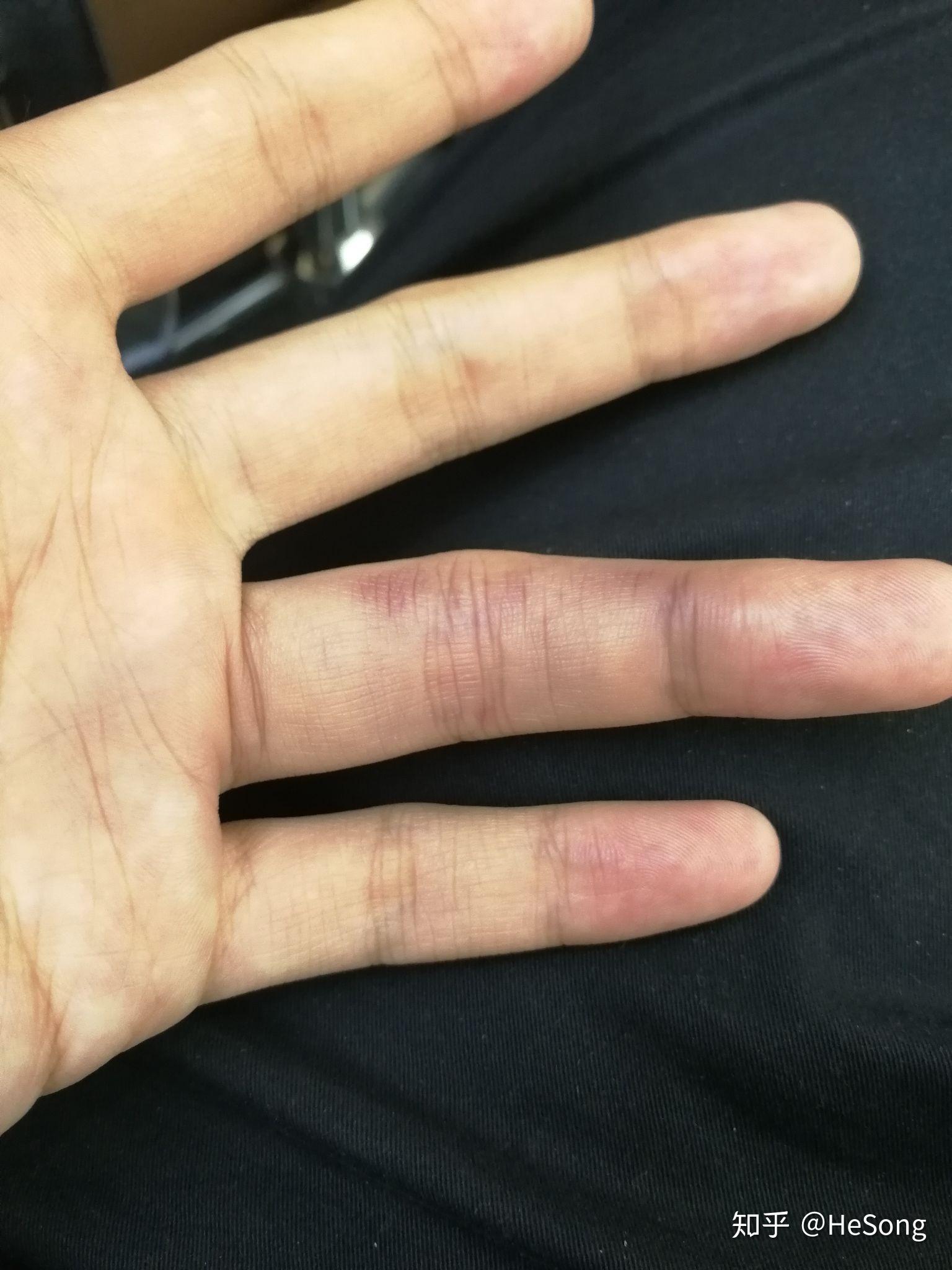 打篮球手指戳伤后该如何处理? - 知乎