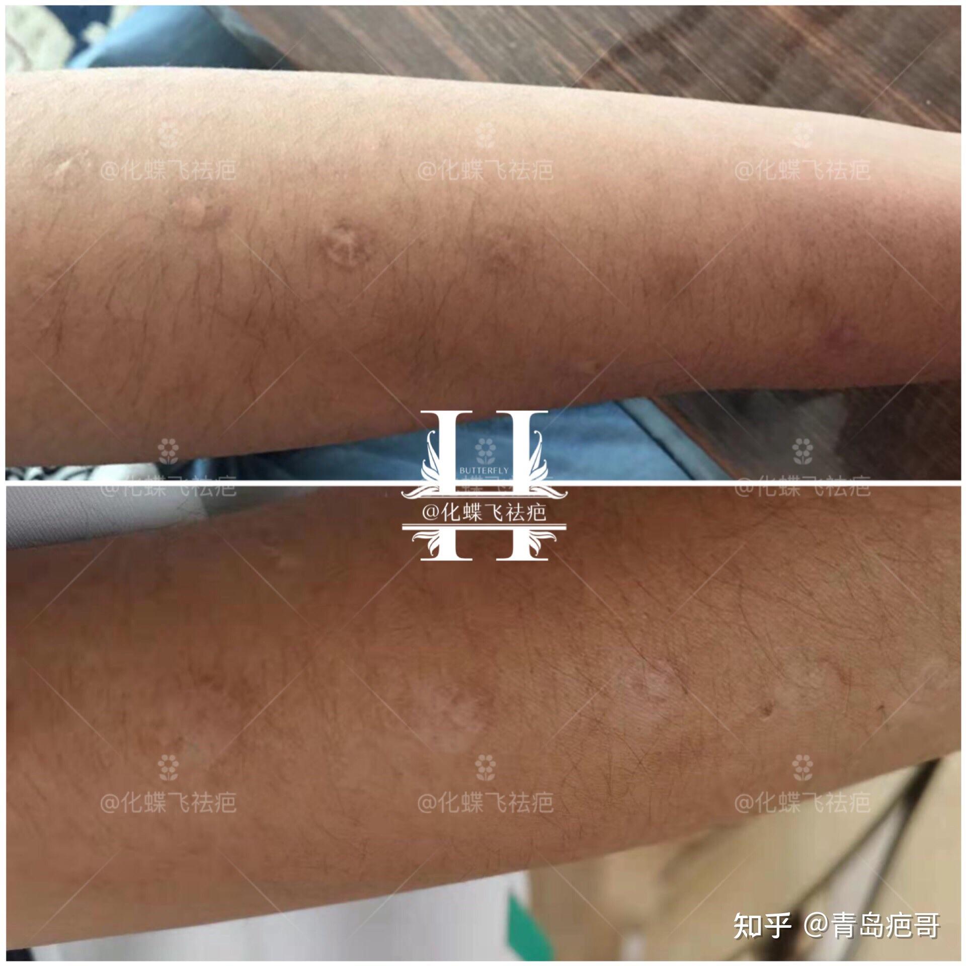 烟疤修复谁都有年少轻狂的时候