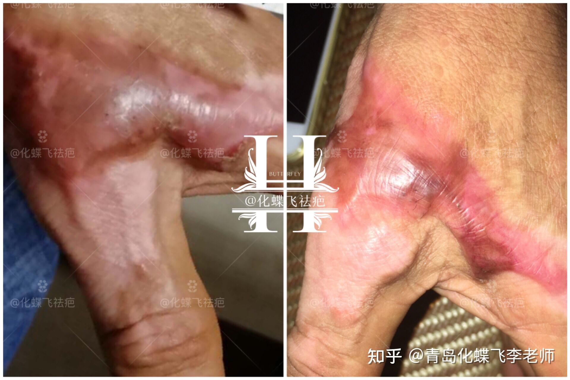 电击烧伤增生疤痕