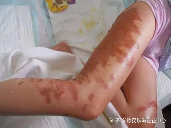 珠海人在海边如果看到这种塑料袋立刻跑千万别犹豫