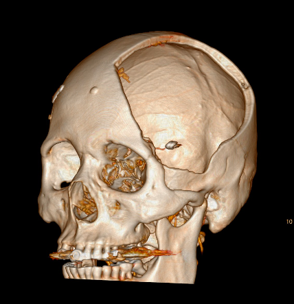 骨头已经不是无菌状态,二是时间长了骨头内部因为缺乏供血而成为死骨