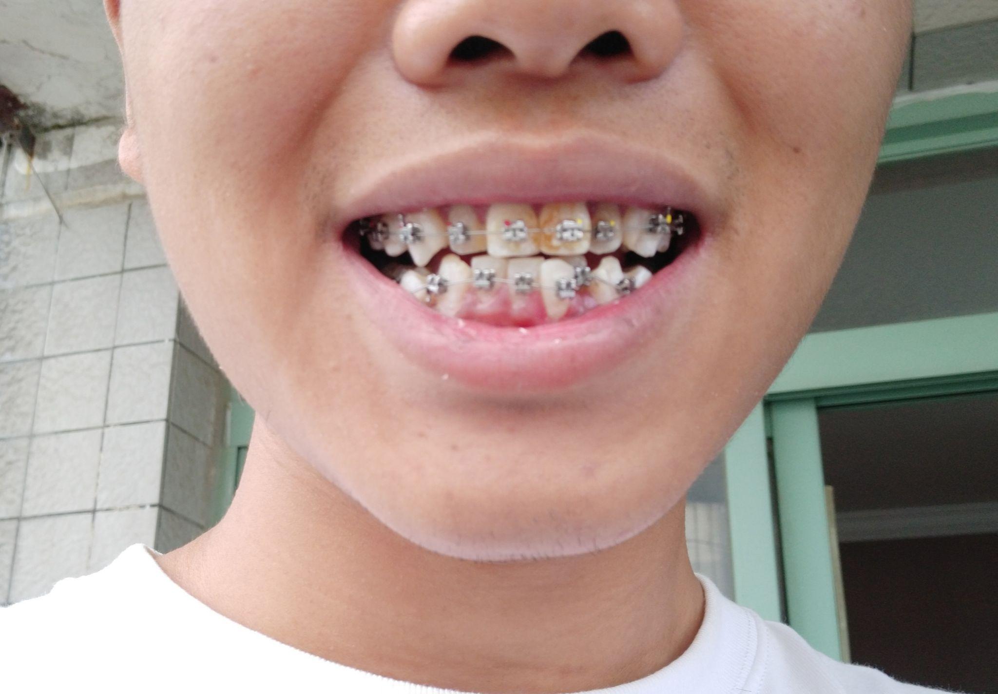 戴牙套花了你多少钱?