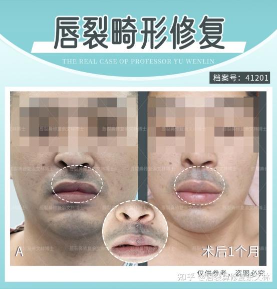 单侧唇裂鼻畸形修复后,变化也太大了吧! - 知乎