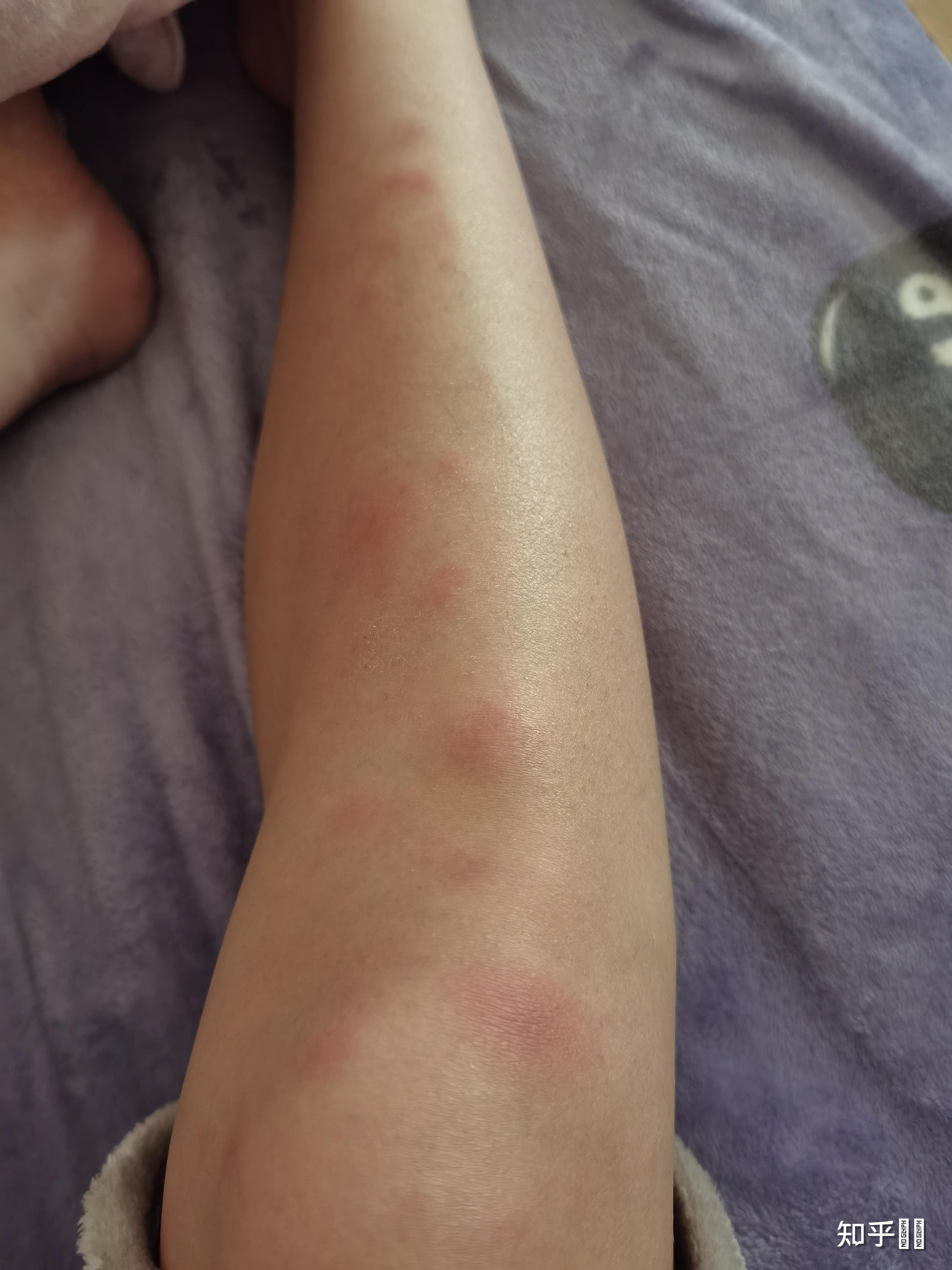 得过结节性红斑的人过来交流下