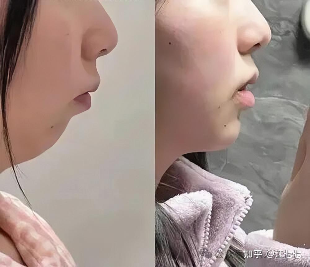 正颌手术的关键,在 “联合” 二字 ,非常不建议正颌和正畸分开找医院做! - 知乎