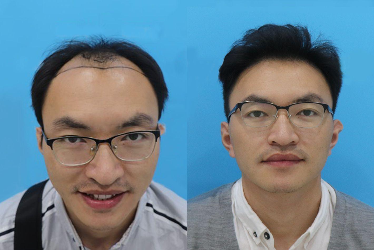 北京男士发际线植发（李翰林）案例分享 - 知乎