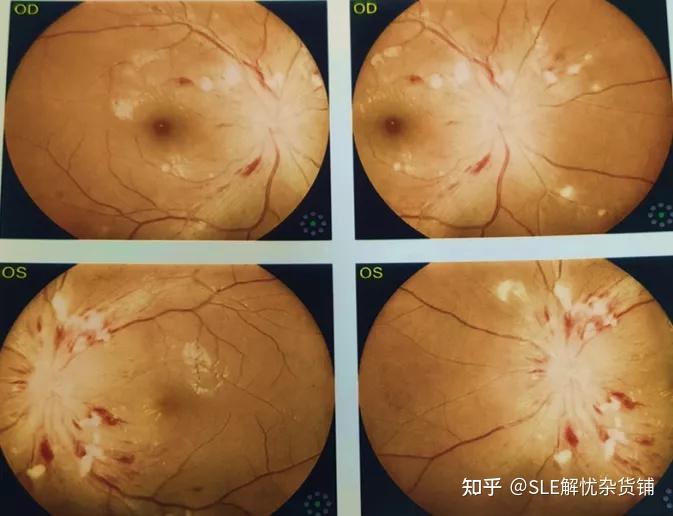 风医蝶友狼疮眼病复杂多样这个多学科门诊为你护眼