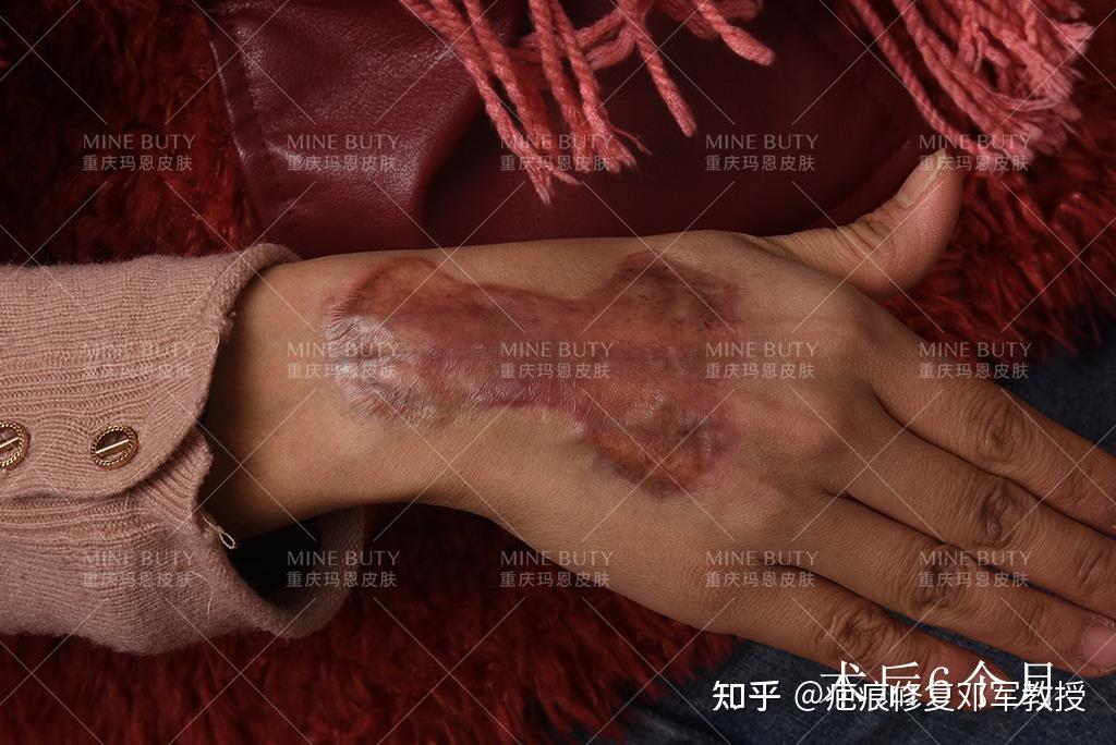 疤痕疙瘩在中医上为什么被称为"蟹足肿"?