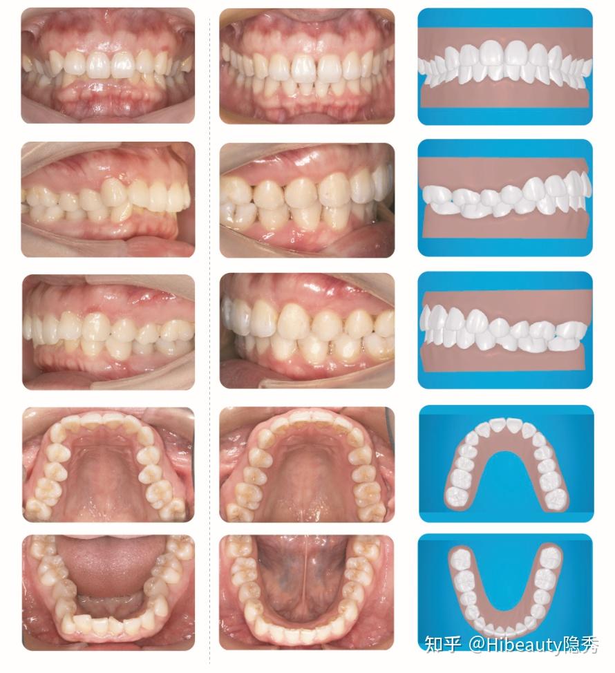 hibeauty隐秀「牙弓狭窄 内倾型深覆合」案例分享