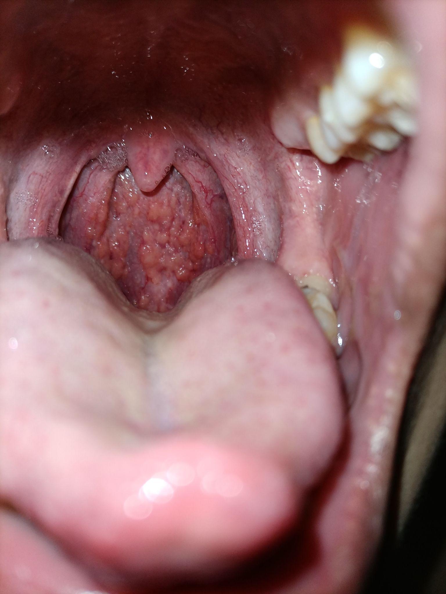 67 写回答 登录/注册 慢性咽炎 最近一周左右患上了咽后壁滤泡增生