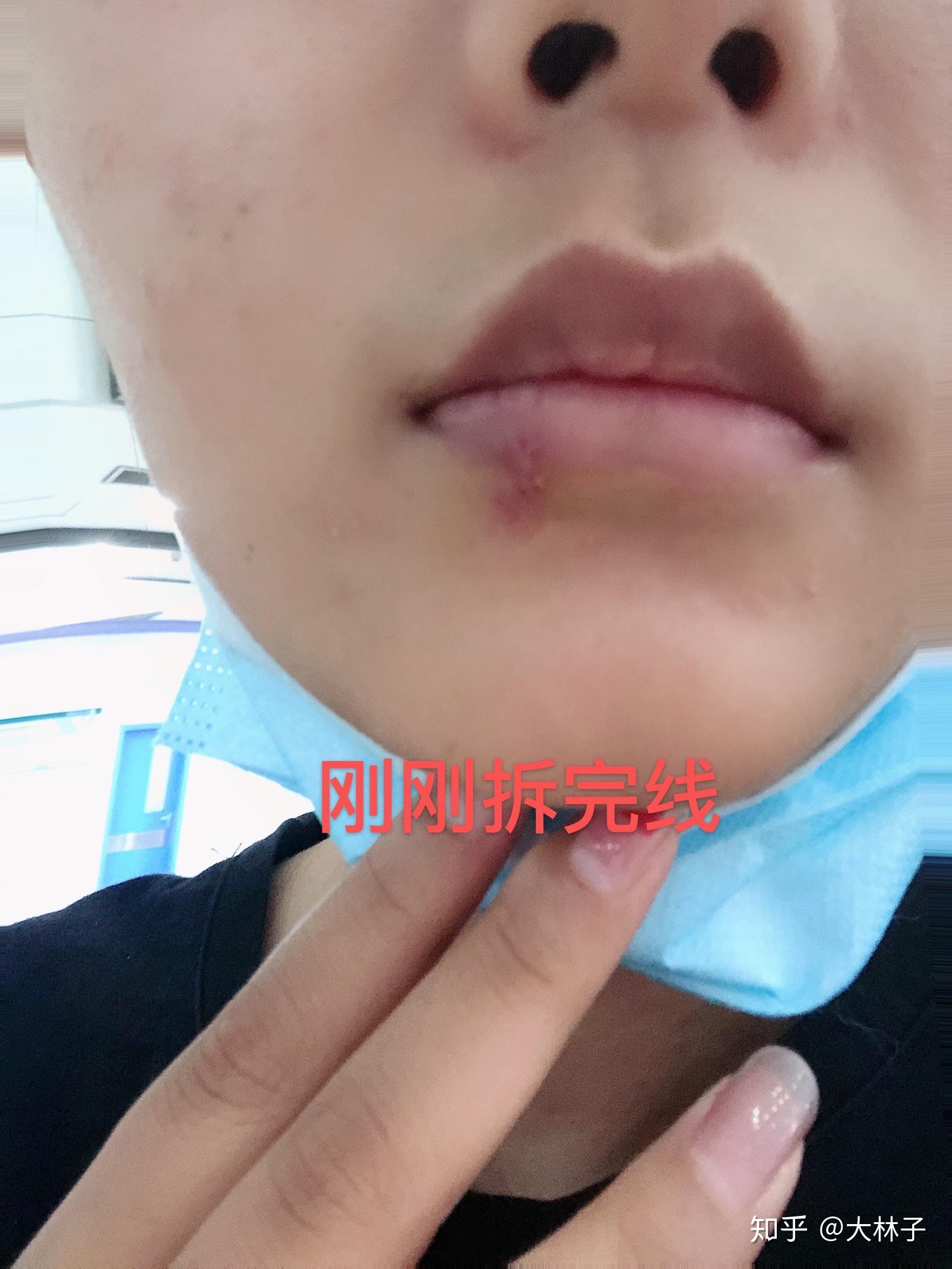 就是线太细了,不好拆,个人感觉拆线比我做手术还要疼 ,疼了一手心的汗