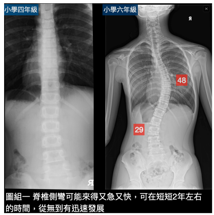 脊柱側彎的症狀及徵兆