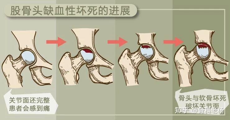 缺血性坏死图片