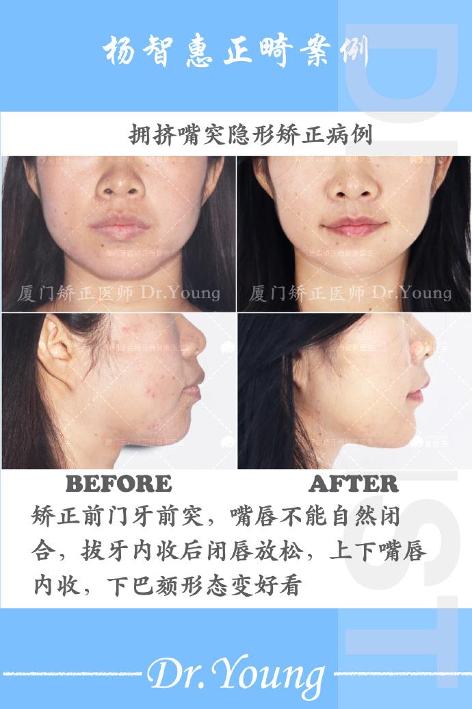 厦门牙齿矫正|牙列拥挤,嘴凸隐形矫正案利分享 - 知乎