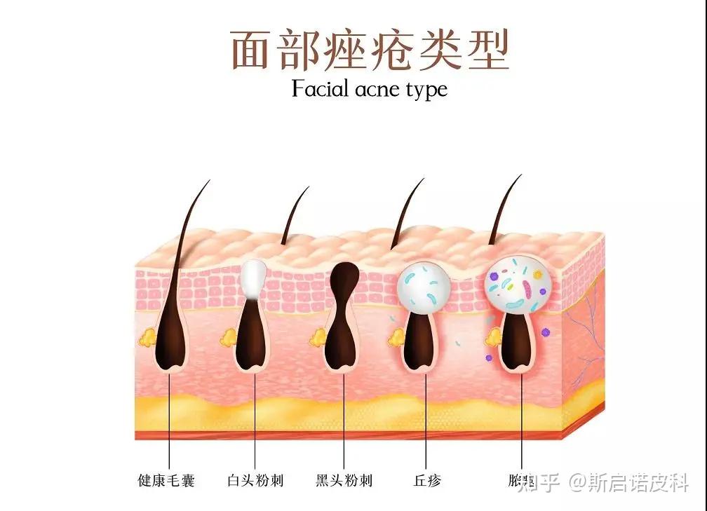 aopt超光子丨王炸級cp痘痘肌管理秘籍