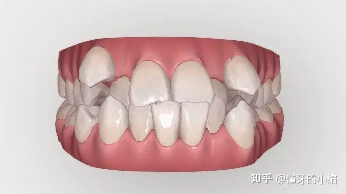 你真的了解牙齿正畸吗