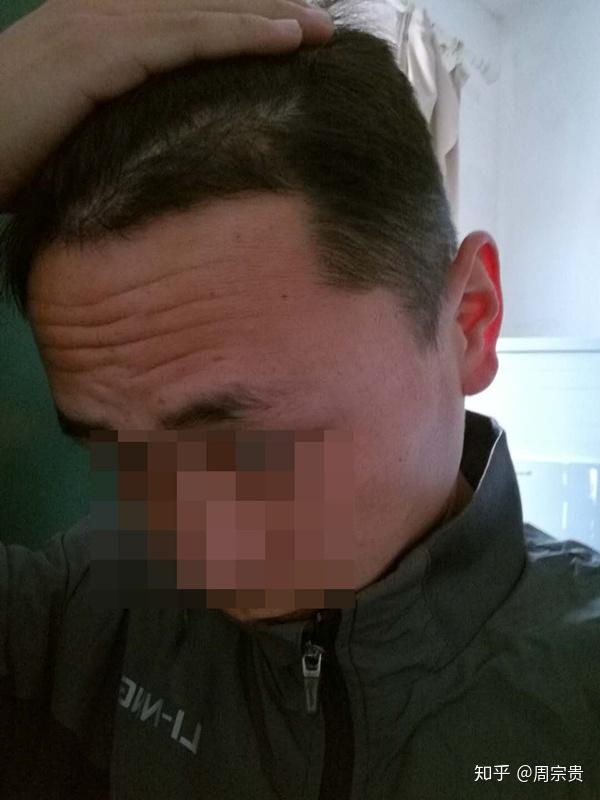 76 植发后半个月术后半个月,孙先生光秃的额角已经被小发茬填满