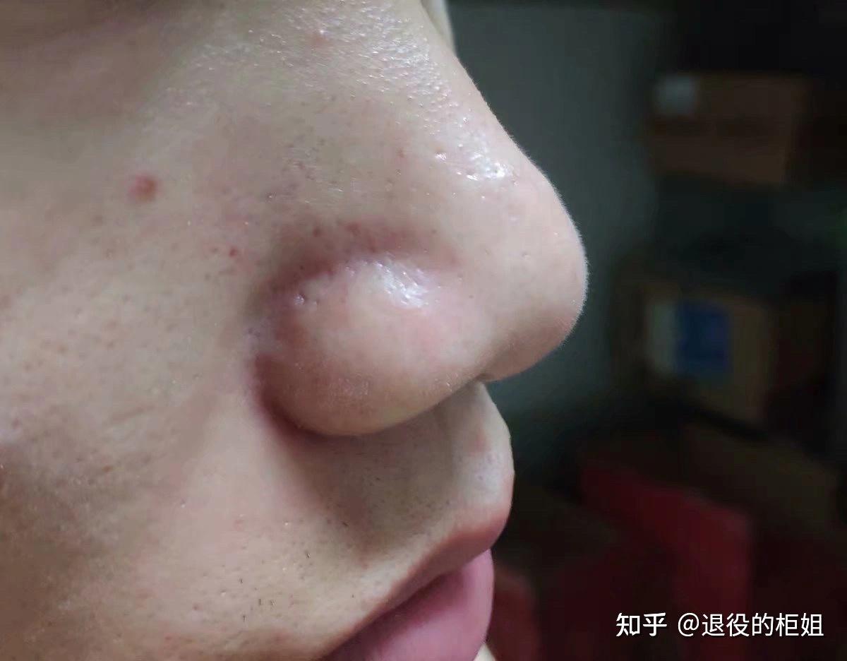 下图就是典型的黑头:典型的黑头鼻,鼻子毛孔里有一颗颗油脂颗粒堵