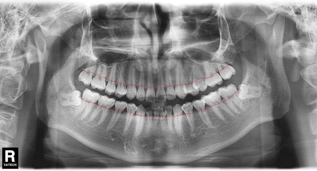 牙槽骨高度大概位于牙齿牙颈部我用红线将是上面患者的牙槽骨高度标记