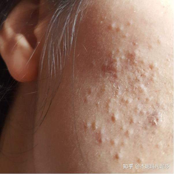为什么皮肤摸上去感觉皮下组织有颗粒,挤出来是白色的东西是什么?