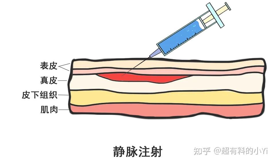 1 肌肉/肌内注射注射部位为上臂三角肌,屁股(臀大肌/臀中肌/臀小肌)