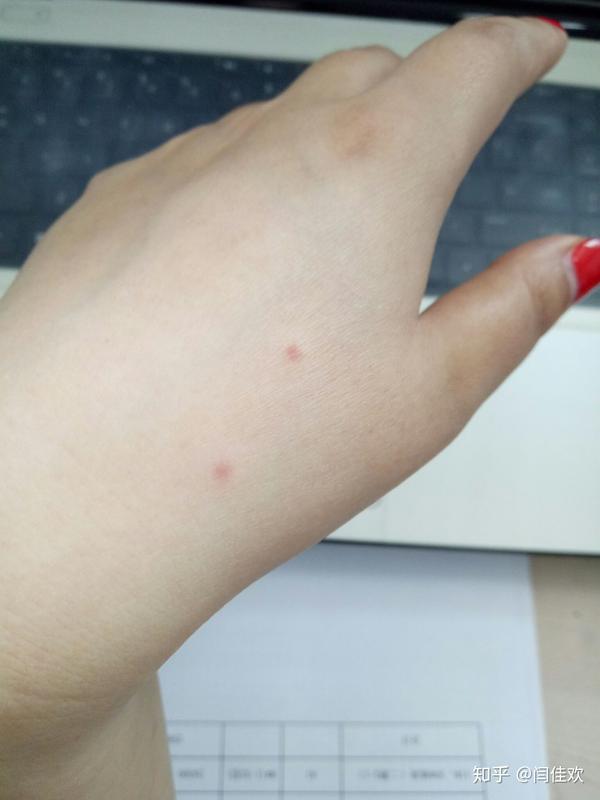 被蚊子咬的小红点图片