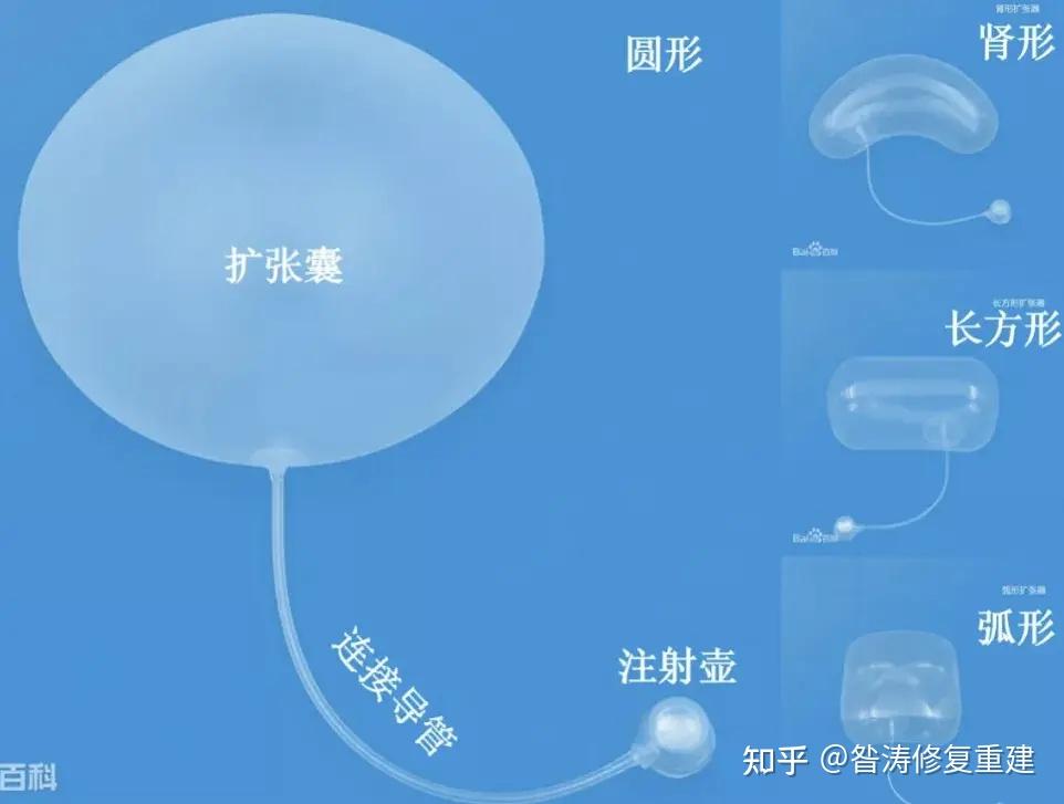 扩张器|临床扩张器的定制 - 知乎