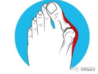 拇指外翻的人一般都有这几个困扰