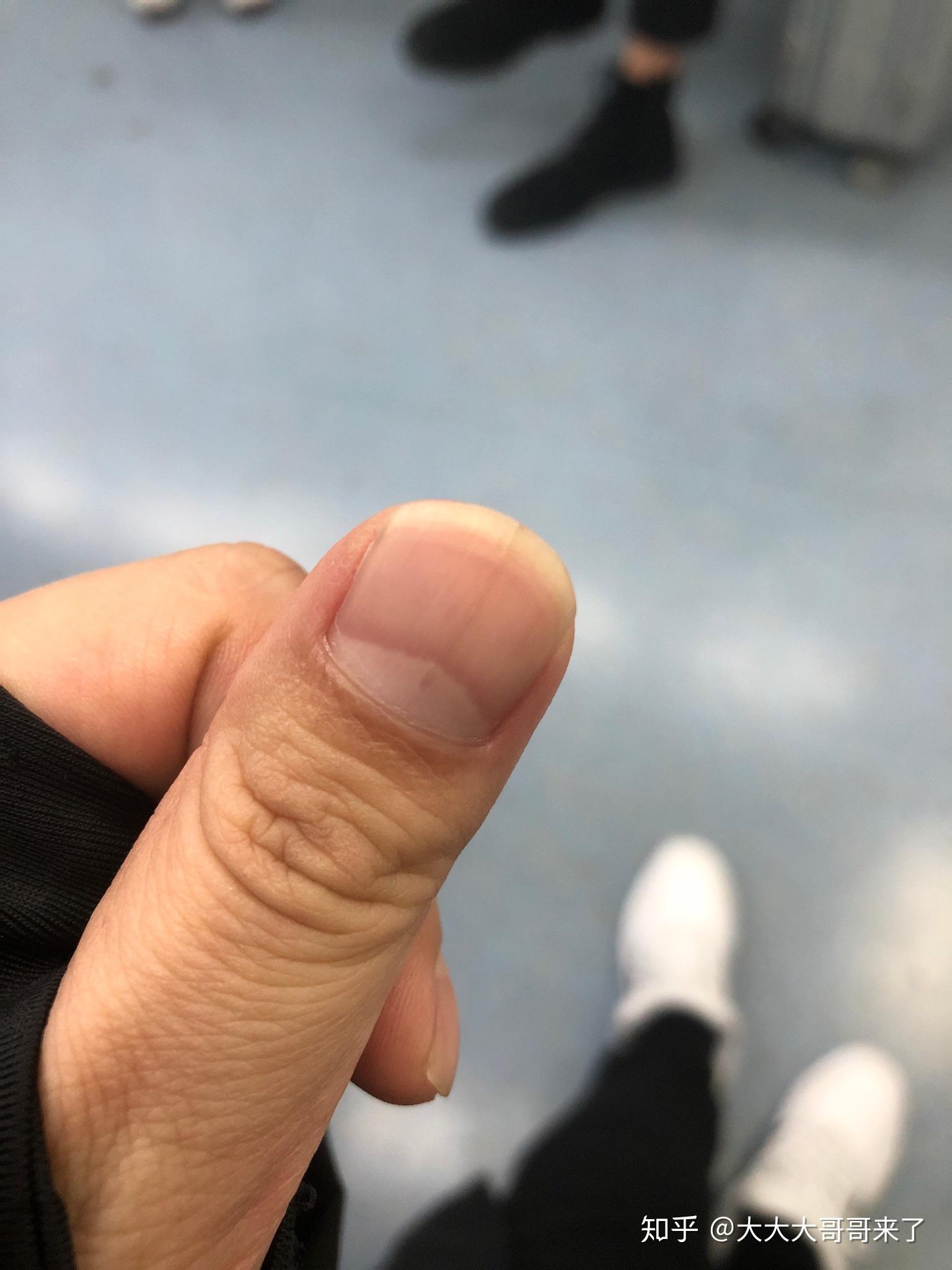 大拇指指甲上有一条褐色的竖线怎么回事