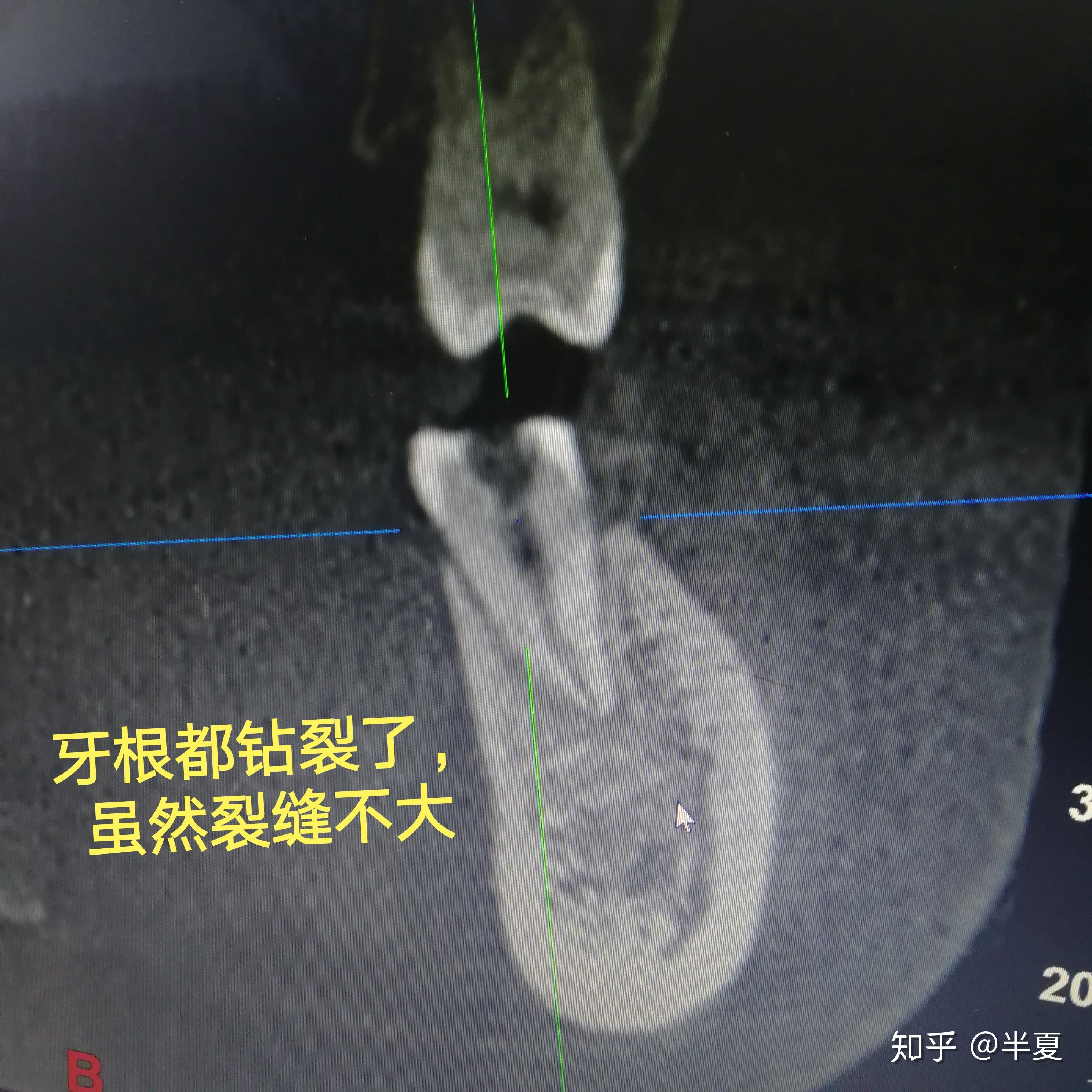 牙内根管治疗过程图片下载 - 觅知网