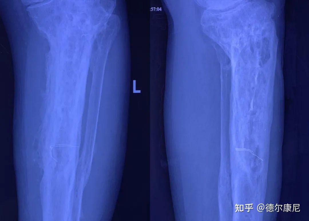 病例|骨髓炎——在绝望中寻找希望